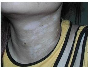 白癜风图片 白癜风图片