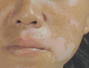 白癜风图片 白癜风图片